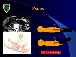 Psoas Sinal de Lapinsky* 