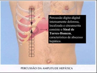 Percussão dígito-digital intensamente dolorosa, localizada e circunscrita consiste o  Sinal de Torres-Homem , característico de abscesso hepático. 
