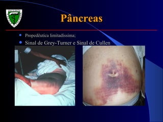 Pâncreas Propedêutica limitadíssima;  Sinal de Grey-Turner e Sinal de Cullen 