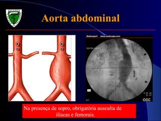 Aorta abdominal Na presença de sopro, obrigatória ausculta de  ilíacas e femorais. 