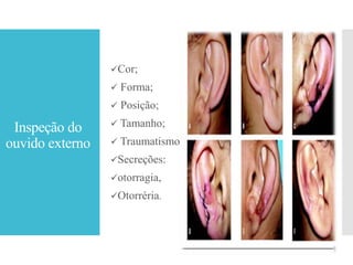 Inspeção do
ouvido externo
Cor;
 Forma;
 Posição;
 Tamanho;
 Traumatismo
Secreções:
otorragia,
Otorréria.
 