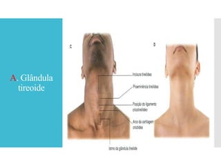 A. Glândula
tireoide
 