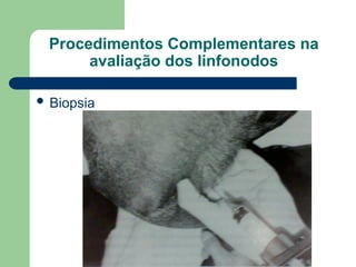 Procedimentos Complementares na
avaliação dos linfonodos
 Biopsia
 