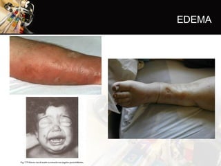 EDEMA
 