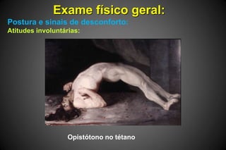 Exame físico geral:
Postura e sinais de desconforto:
Atitudes involuntárias:
Opistótono no tétano
 