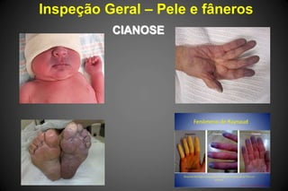 Inspeção Geral – Pele e fâneros
CIANOSE
 