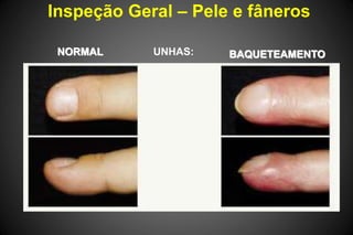 Inspeção Geral – Pele e fâneros
NORMAL BAQUETEAMENTOUNHAS:
 