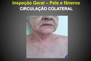 Inspeção Geral – Pele e fâneros
CIRCULAÇÃO COLATERAL
 