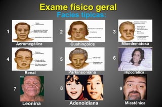 Exame físico geral
Facies típicas:
Miastênica
1 2 3
4 5 6
7 8 9
Acromegálica Cushingóide Mixedematosa
Renal Parkinsoniana Hipocrática
AdenoidianaLeonina
 