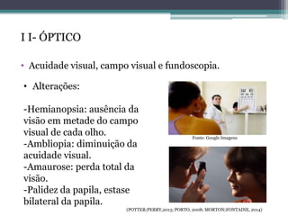 I I- ÓPTICO
• Acuidade visual, campo visual e fundoscopia.
• Alterações:
-Hemianopsia: ausência da
visão em metade do campo
visual de cada olho.
-Ambliopia: diminuição da
acuidade visual.
-Amaurose: perda total da
visão.
-Palidez da papila, estase
bilateral da papila.
(POTTER;PERRY,2013; PORTO, 2008; MORTON;FONTAINE, 2014)
Fonte: Google Imagens
 