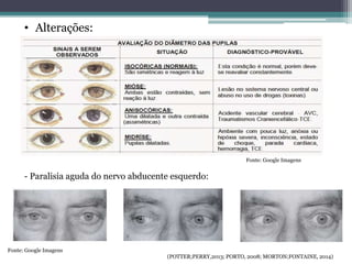 • Alterações:
- Paralisia aguda do nervo abducente esquerdo:
(POTTER;PERRY,2013; PORTO, 2008; MORTON;FONTAINE, 2014)
Fonte: Google Imagens
Fonte: Google Imagens
 
