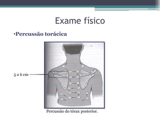 Exame físico
•Percussão torácica
Percussão do tórax posterior.
5 a 6 cm
 