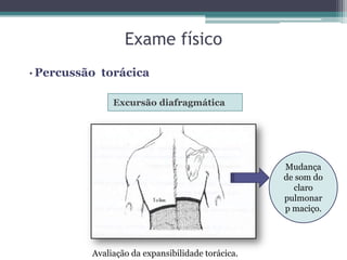 Exame físico
Excursão diafragmática
• Percussão torácica
Avaliação da expansibilidade torácica.
Mudança
de som do
claro
pulmonar
p maciço.
 