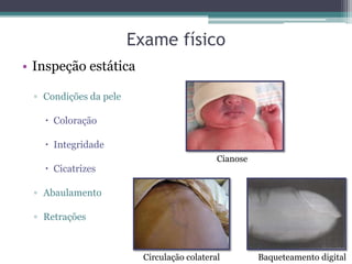 Exame físico
• Inspeção estática
▫ Condições da pele
 Coloração
 Integridade
 Cicatrizes
▫ Abaulamento
▫ Retrações
Baqueteamento digitalCirculação colateral
Cianose
 