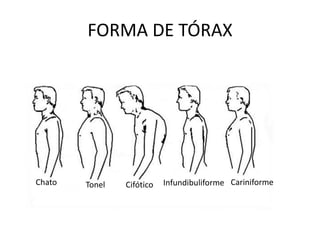 FORMA DE TÓRAX
Chato Tonel Cifótico CariniformeInfundibuliforme
 