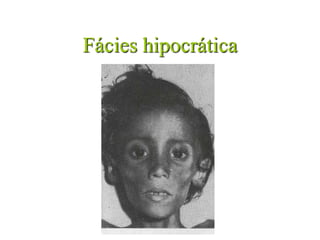 Fácies hipocrática
 