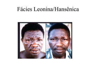 Fácies Leonina/Hansênica
 