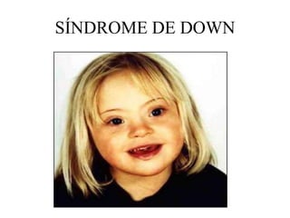 SÍNDROME DE DOWN
 