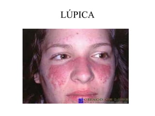 LÚPICA
 