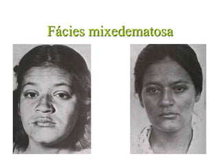 Fácies mixedematosa
 