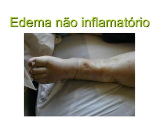 Edema não inflamatório
 