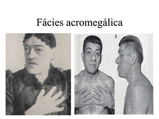 Fácies acromegálica
 