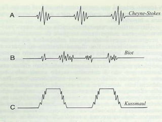 Cheyne-Stokes
Biot
Kussmaul
 