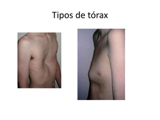 Tipos de tórax
 