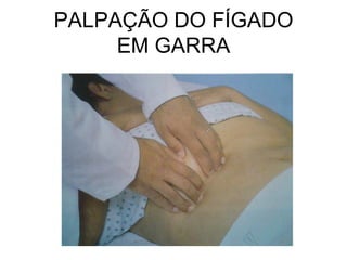 PALPAÇÃO DO FÍGADO
EM GARRA
 