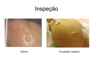 Inspeção
Edema Circulação colateral
 