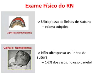 Exame Físico do RN
-> Ultrapassa as linhas de sutura
– edema subgaleal
-> Não ultrapassa as linhas de
sutura
– 1-2% dos casos, no osso parietal
 