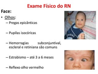 Exame Físico do RN
Face:
• Olhos:
– Pregas epicânticas
– Pupilas isocóricas
– Hemorragias subconjuntival,
escleral e retiniana são comuns
– Estrabismo – até 3 a 6 meses
– Reflexo olho vermelho
 