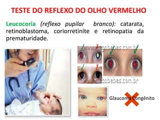 Leucocoria (reflexo pupilar branco): catarata,
retinoblastoma, coriorretinite e retinopatia da
prematuridade.
Glaucoma Congênito
TESTE DO REFLEXO DO OLHO VERMELHO
 