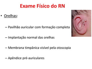 Exame Físico do RN
• Orelhas:
– Pavilhão auricular com formação completa
– Implantação normal das orelhas
– Membrana timpânica visível pela otoscopia
– Apêndice pré-auriculares
 