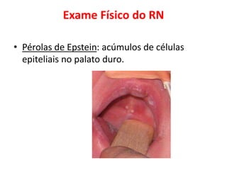 Exame Físico do RN
• Pérolas de Epstein: acúmulos de células
epiteliais no palato duro.
 
