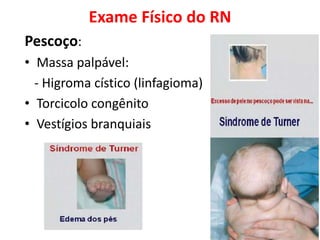 Exame Físico do RN
Pescoço:
• Massa palpável:
- Higroma cístico (linfagioma)
• Torcicolo congênito
• Vestígios branquiais
 