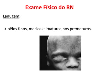 Exame Físico do RN
Lanugem:
-> pêlos finos, macios e imaturos nos prematuros.
 