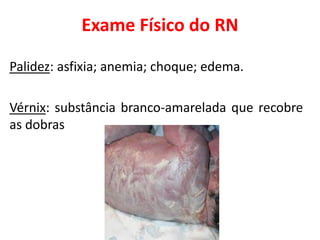 Exame Físico do RN
Palidez: asfixia; anemia; choque; edema.
Vérnix: substância branco-amarelada que recobre
as dobras
 