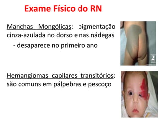 Exame Físico do RN
Manchas Mongólicas: pigmentação
cinza-azulada no dorso e nas nádegas
- desaparece no primeiro ano
Hemangiomas capilares transitórios:
são comuns em pálpebras e pescoço
 