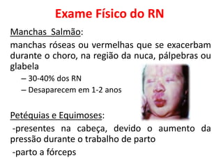 Exame Físico do RN
Manchas Salmão:
manchas róseas ou vermelhas que se exacerbam
durante o choro, na região da nuca, pálpebras ou
glabela
– 30-40% dos RN
– Desaparecem em 1-2 anos
Petéquias e Equimoses:
-presentes na cabeça, devido o aumento da
pressão durante o trabalho de parto
-parto a fórceps
 
