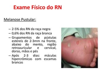 Exame Físico do RN
Melanose Pustular:
– 2-5% dos RN da raça negra
– 0,6% dos RN da raça branca
– Grupamentos de pústulas
estéreis de 2-3mm na fronte,
abaixo do mento, região
retroauricular e cervical,
dorso, mãos e pés
– Após 2-3 dias: máculas
hipercrômicas com escamas
brancas
 