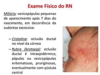 Exame Físico do RN
Miliária: vesicopápulas pequenas
de aparecimento após 7 dias do
nascimento, em decorrência da
sudorese excessiva:
– Cristalina: oclusão ductal
no nível da córnea
– Rubra (brotoeja): oclusão
ductal é intraepidérmica;
pápulas ou vesicopápulas
eritematosas, pruriginosas,
eventualmente com pústula
central
 
