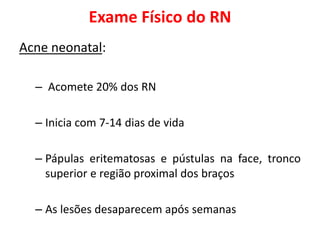 Exame Físico do RN
Acne neonatal:
– Acomete 20% dos RN
– Inicia com 7-14 dias de vida
– Pápulas eritematosas e pústulas na face, tronco
superior e região proximal dos braços
– As lesões desaparecem após semanas
 