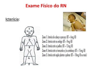 Exame Físico do RN
Icterícia:
 
