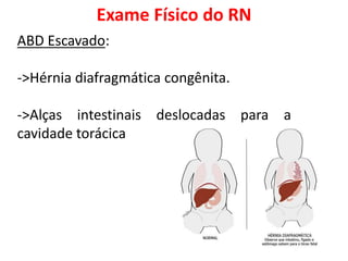 ABD Escavado:
->Hérnia diafragmática congênita.
->Alças intestinais deslocadas para a
cavidade torácica
Exame Físico do RN
 