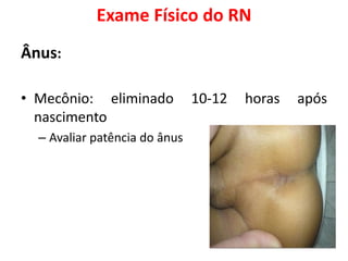 Exame Físico do RN
Ânus:
• Mecônio: eliminado 10-12 horas após
nascimento
– Avaliar patência do ânus
 