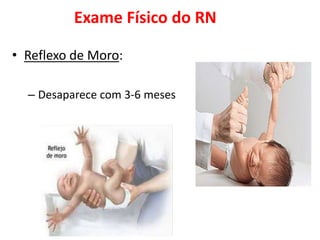 Exame Físico do RN
• Reflexo de Moro:
– Desaparece com 3-6 meses
 