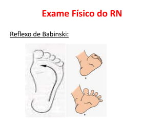 Exame Físico do RN
Reflexo de Babinski:
 