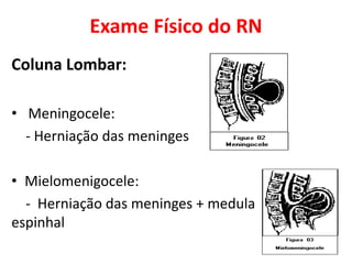 Exame Físico do RN
Coluna Lombar:
• Meningocele:
- Herniação das meninges
• Mielomenigocele:
- Herniação das meninges + medula
espinhal
 