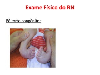 Exame Físico do RN
Pé torto congênito:
 